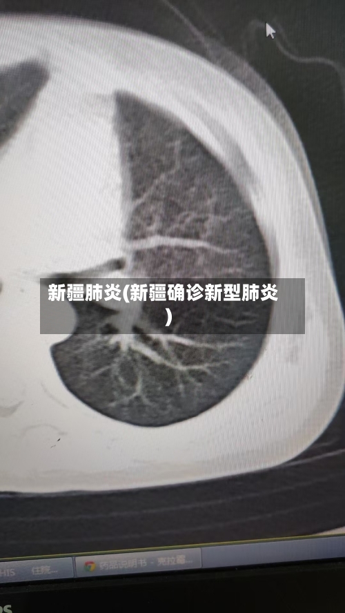 新疆肺炎(新疆确诊新型肺炎)-第1张图片